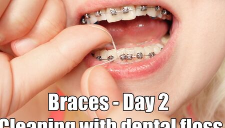 Close up mouth tour, braces and dental floss