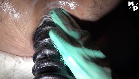 Extremely stretched anal canal