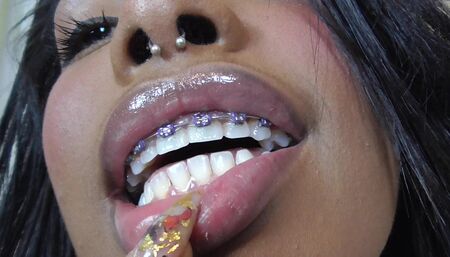 Black girl teeth brace fetish!