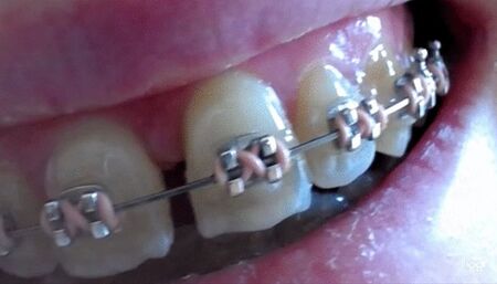 My teeth in brazes to cam mp4