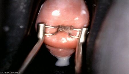 cervix stretch w endocervical speculum (1080 wmv)