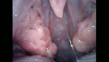 Monstrous tonsils after virus wmv