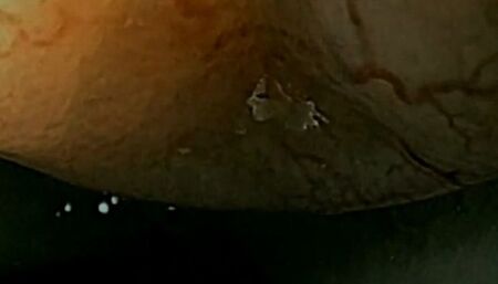 Looped anal trip in hemorrhoid filled asshole - Vore endoscopy video with heartbeat avi