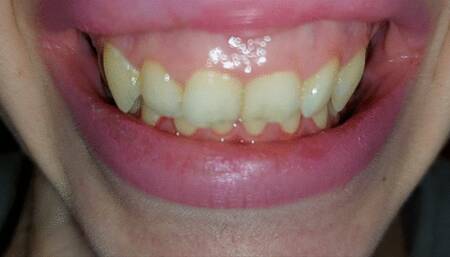 My teeth are chattering - pt9