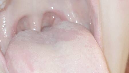 Drooling and gagging