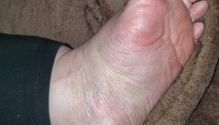 Whole sole callouses check