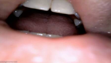 burp endoscopy (1080 wmv)