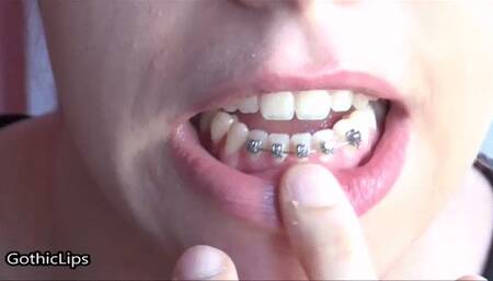 Dental appliance [MORGANA],