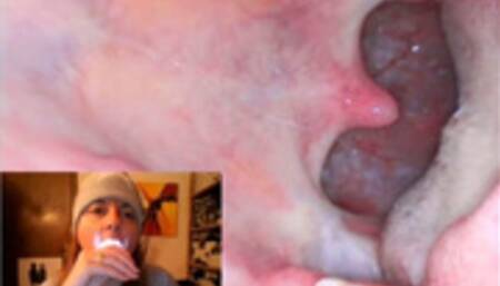 Endoscopy catarrh saliva and mouth exploration 720HD