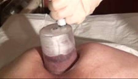 Bizarr Lady uses vacuum pump for my prolapse development