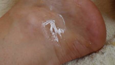 Ankle Heartbeat with Honey