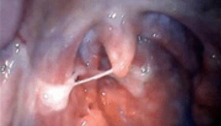 Big phlegm ENDOSCOPY wmv