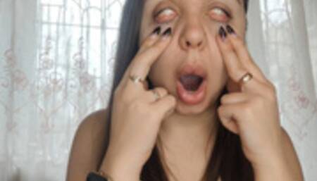 The horrible look of an unhealthy face, " WHITE EYES"