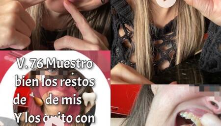 I SHOW CHICKEN REMAINS IN TEETH AND I GET THEM OUT