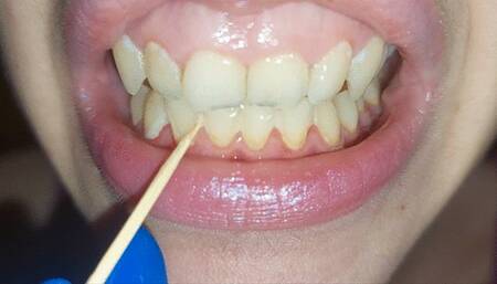 Scratching my teeth with a toothpick