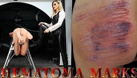 HEMATOMA MARKS mobile version