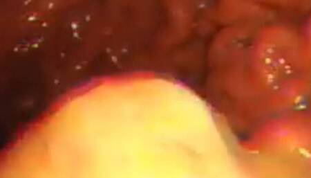 Integral full screen PillCam digestion of orange with clearly visible pieces 720HD