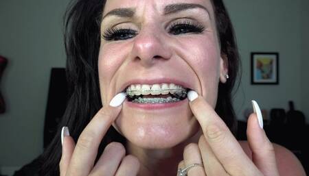 LAUREN'S BRACES & MOUTH TOUR