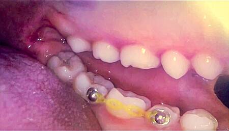 Endoscope: My First Mouth Adventure (Part 2)