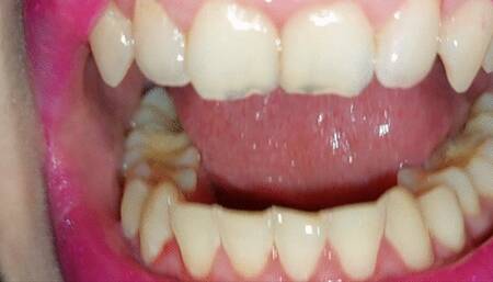 teeth tour - admire my teeth - pt6