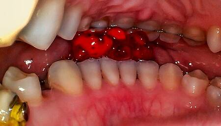 Reverse Gummy Bears Vore