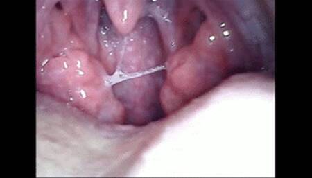 Sick tonsils endoscopy wmv