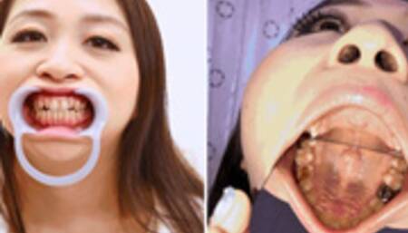 Dental Exploration: Tooth Filling missing Rin Ryomiya's Adventure