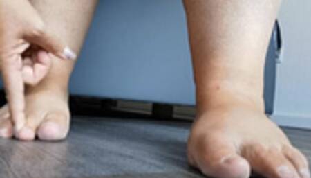 Foot Deformities MP4