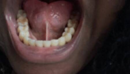 Getting all the LITTLE PEOPLE Out of My TEETH