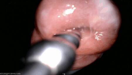 cervix treble sound endoscopy