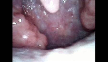 Hiccups endoscopy  wmv