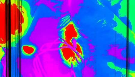 Beta Censored Relapse-Fantasy