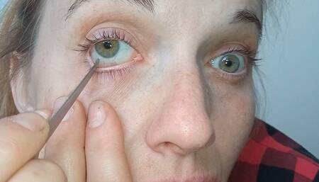 Emergency surgery on my eyes