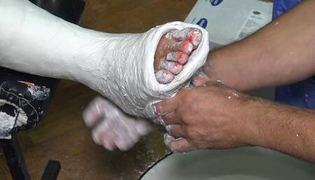 Kamilla short leg cast