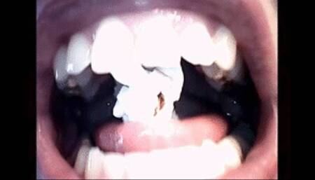 Endoscopic crushing wmv