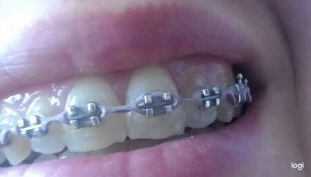 Teeth with brazers to cam mp4