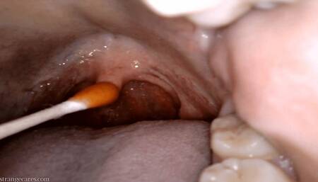 uvula cholula: direct hot sauce application with swab (720 mp4)