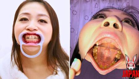 Dental Exploration: Missing Filling and a full crown Rin Suzumiya's Oral Adventure