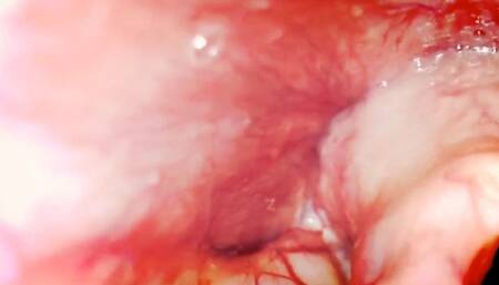 Down my throat - New extreme exploration with the Pillcam 1080HD