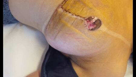 Post surgery 3 weeks - scars and nipple healing