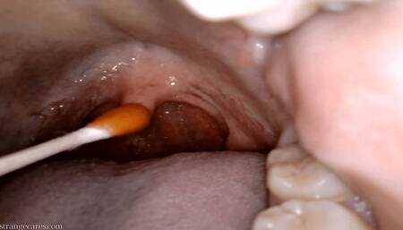 uvula cholula: direct hot sauce application with swab (1080 wmv)