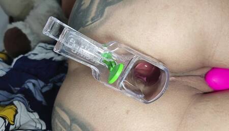 Speculum Anal