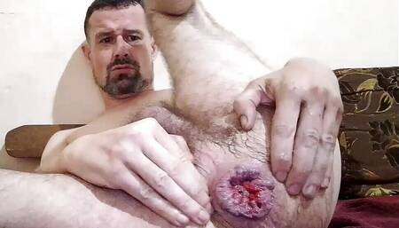 Allowing the Prolapse