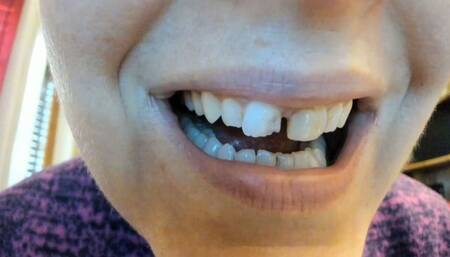 Broken incisor - real broken incisor 1080HD