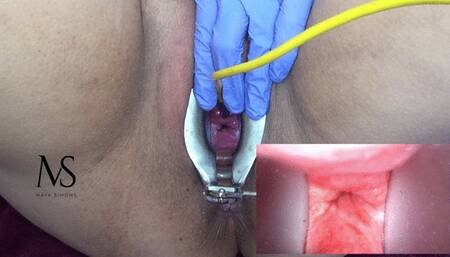 injecting coke cola into my uterus