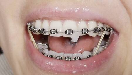 EPIC handjob with cum on BRACES and elastics!