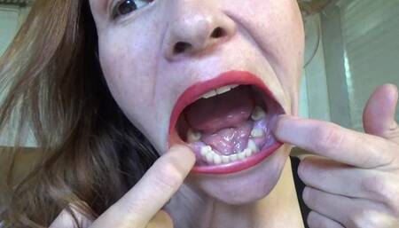 Sarah's New Fillings