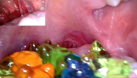 Vore- gummy bears endoscopy