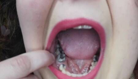 Silver filling mouth tour
