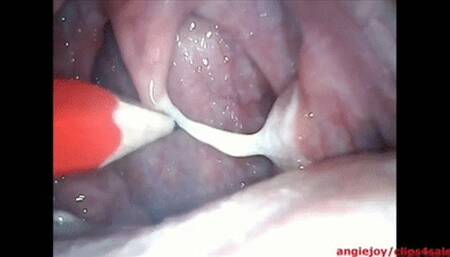 Phlegm eruption in the throat